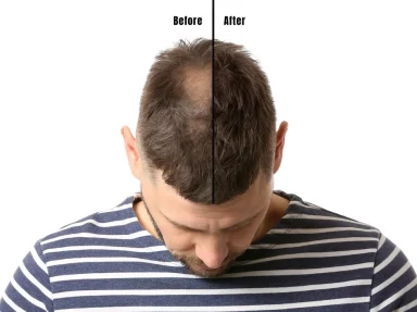 Thicker hair with Finasteride. Unlock the secret to hair growth and regrowth with Finasteride